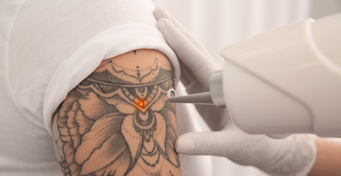 Indian-Ink Tattoo Removal & Body Piercing | Dundee