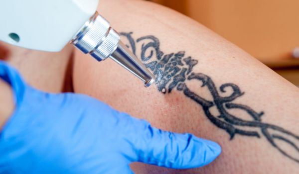 Laser Tattoo Removal